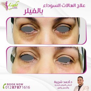 علاج الهالات السوداء بالفيلر