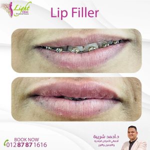 فيلر الشفايف