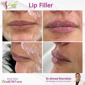 فيلر الشفايف