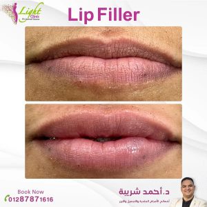 من نتائج فيلر الشفايف في عيادات لايت كلينك