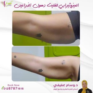 ميزوثيرابي لتفتيت الدهون بالذراعين