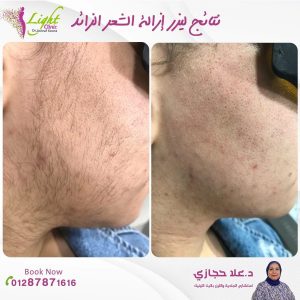 نتائج إزالة الشعر بالليزر