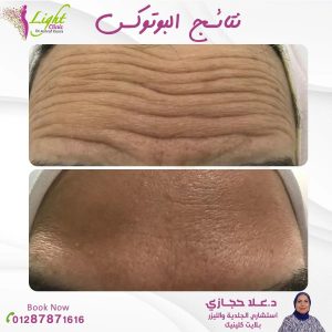 نتائج البوتكس