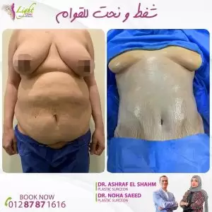 نتائج شفط ونحت القوام