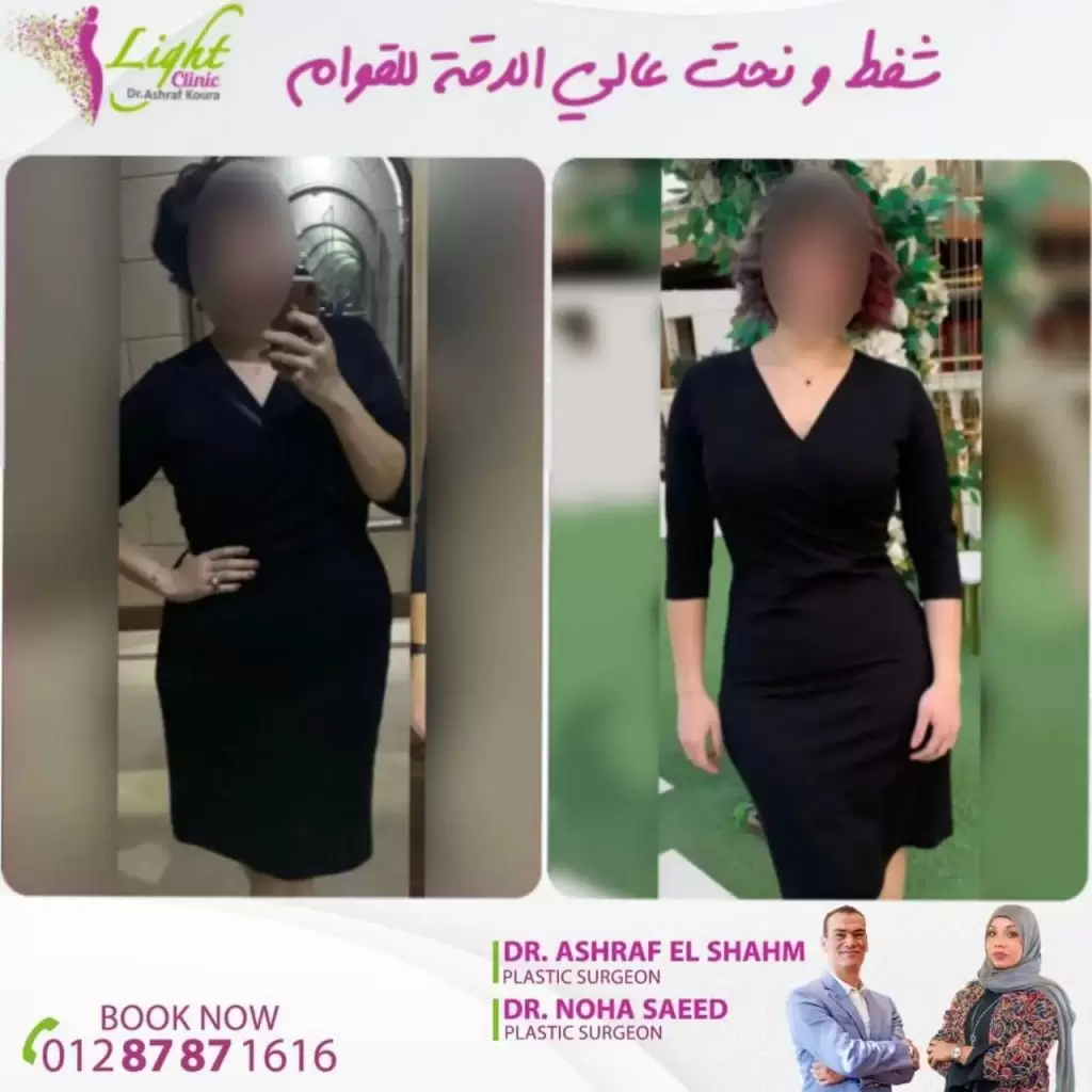 اسعار عمليات شفط الدهون فى مصر
