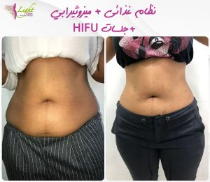 نتائج نظام غذائي مع الميزوثيرابي وجلسات هايفو