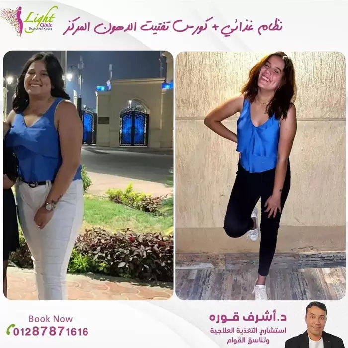 أسعار جلسات تجميد الدهون