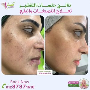 جلسات التقشير لعلاج التصبغات