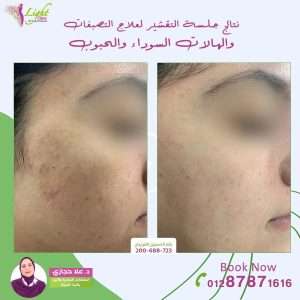 جلسة تقشير لعلاج التصبغات والهالات السوداء والحبوب