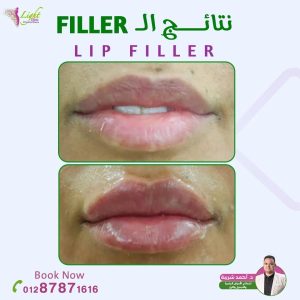 نتائج حقن الفيلر للشفايف