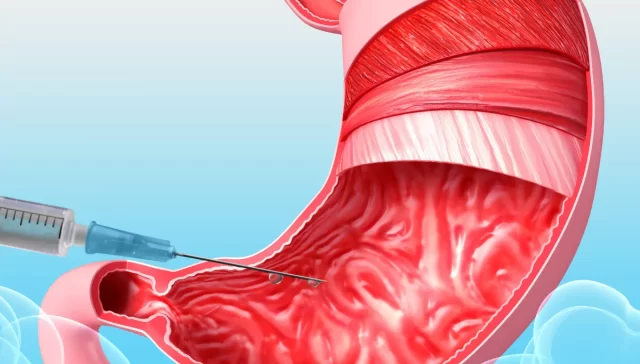 أسعار عملية بوتكس المعدة في مصر