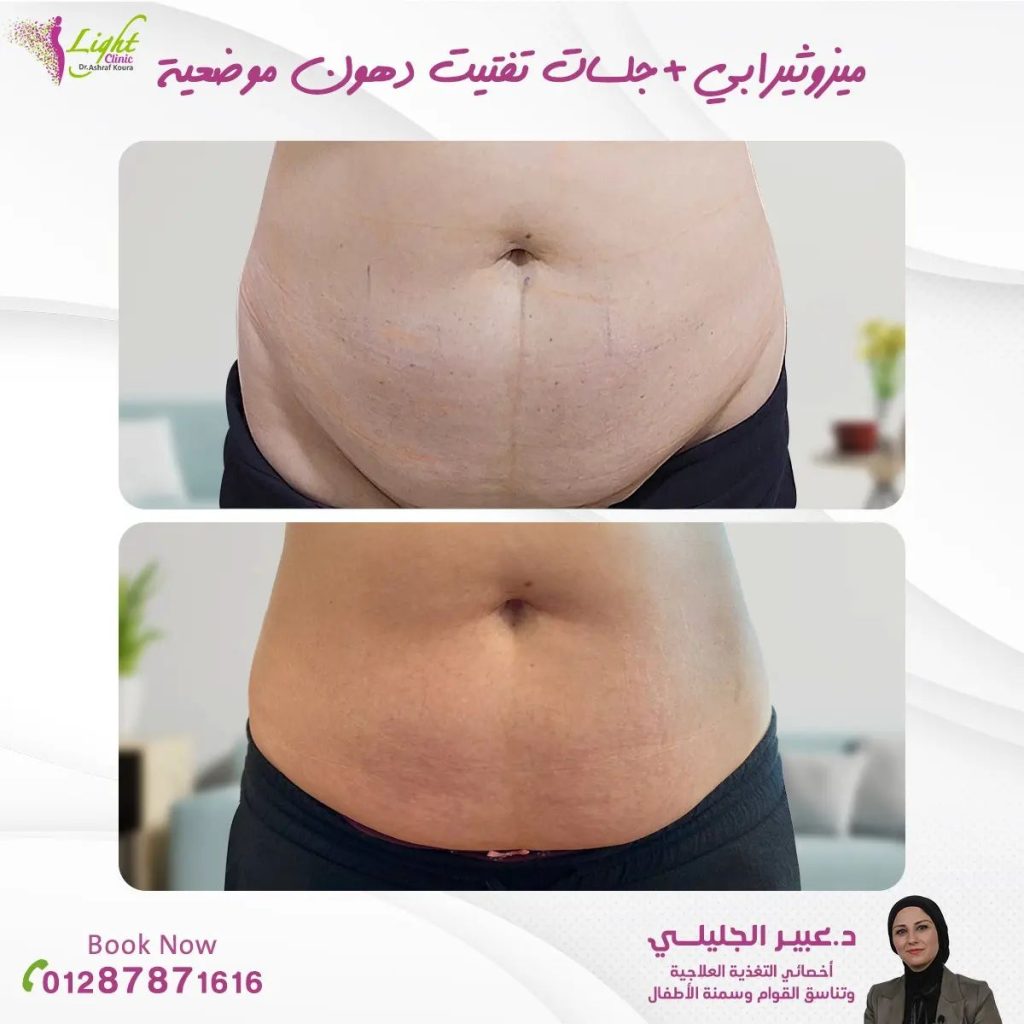 جلسات ميزوثيرابي مع تفتيت دهون موضعية