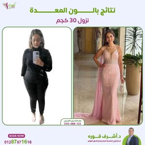 أفضل عمليات التخسيس بدون جراحة لعام 2024 8 نتائج بالون المعدة قبل وبعد