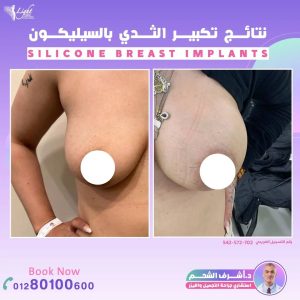 نتائج تكبير الثدي بحشوات السيليكون