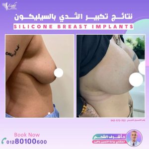 نتائج تكبير الثدي بحشوات السيليكون