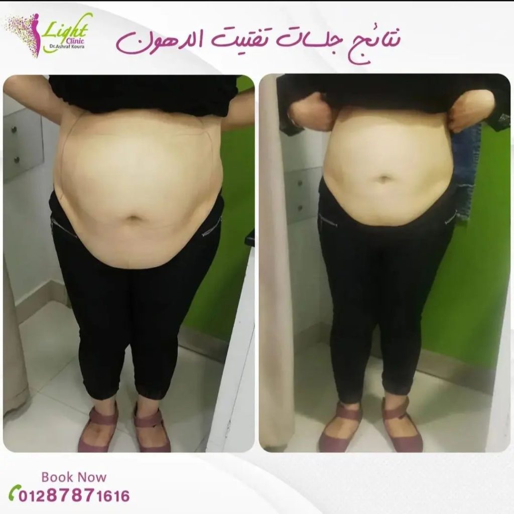 نتائج جلسات تفتيت الدهون