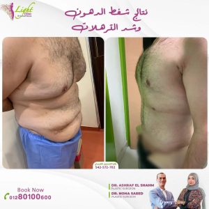 نتائج شفط الدهون وشد الترهلات