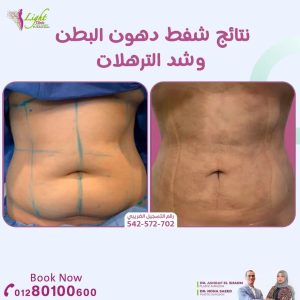 نتائج شفط دهون البطن وشد الترهلات