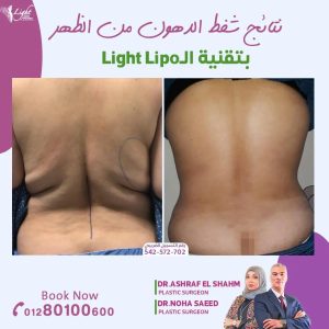 نتائج شفط دهون الظهر