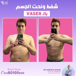 نتائج شفط ونحت الجسم بالفيزر