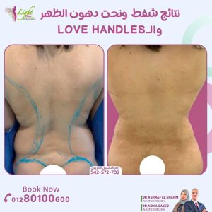 نتائج شفط ونحت الظهر