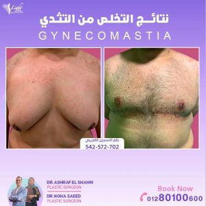 نتائج علاج التثدي