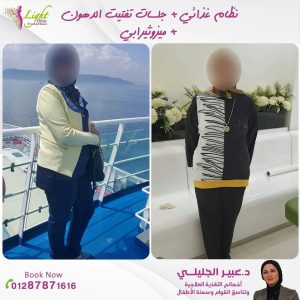 نتائج نظام غذائي مع الميزوثيرابي وجلسات هايفو