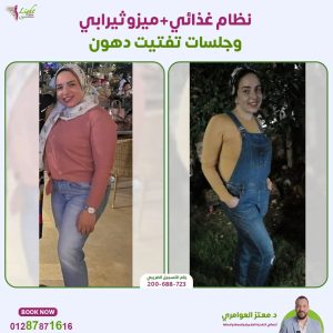 نتائج نظام غذائي وميزوثيرابي وجلسات تفتيت دهون