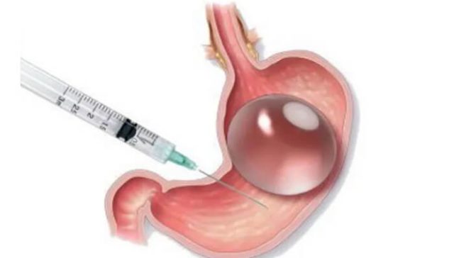 بوتكس المعدة للتخسيس