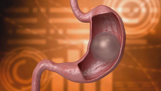 الفرق بين بالون المعدة الأمريكي والروسي