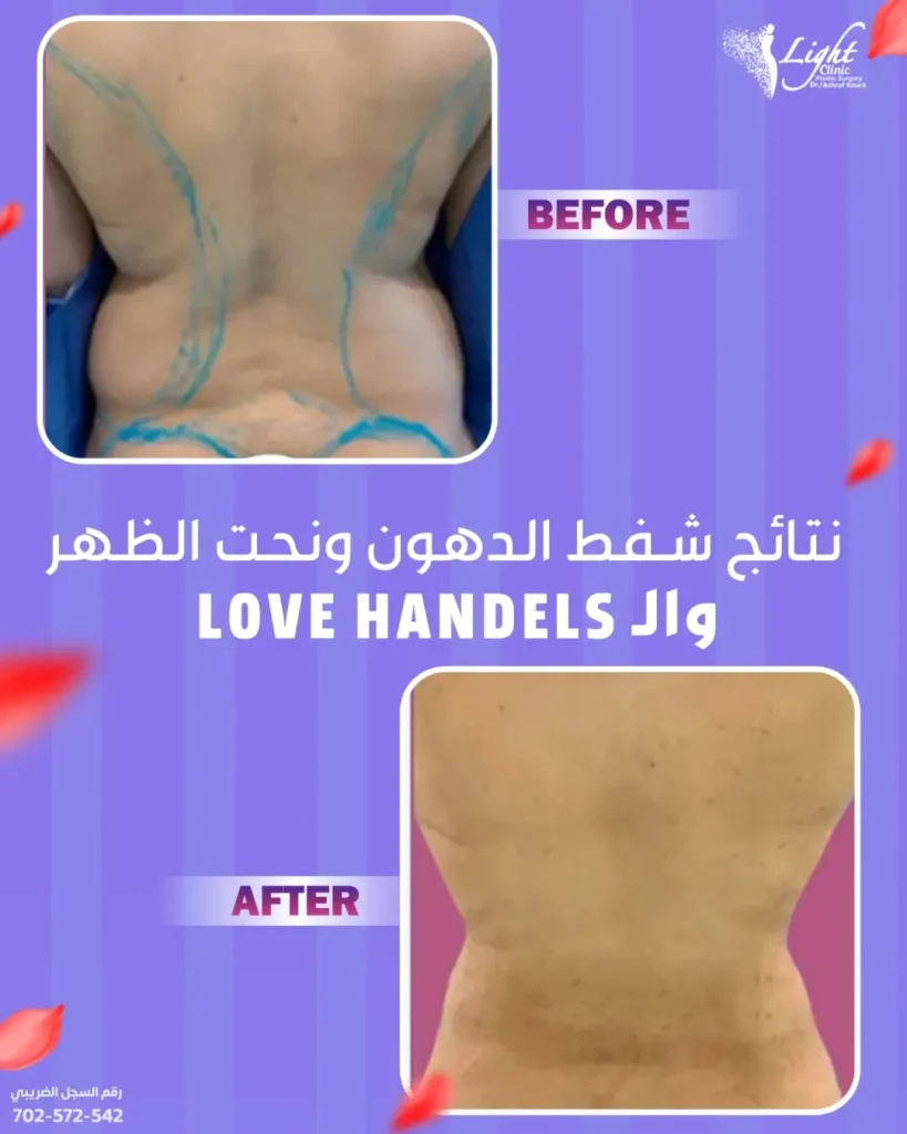 الدهون أسفل الظهر بالفيزر في عيادات لايت كلينك